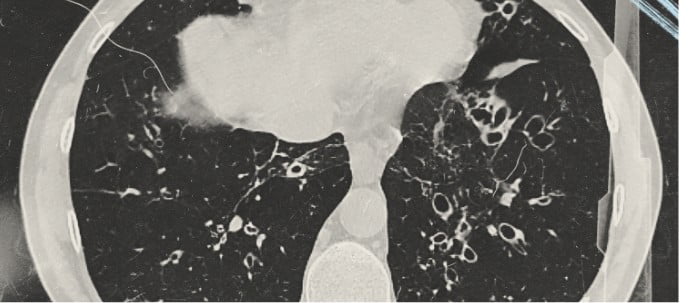 CT scan displaying a pair of lungs affected by bronchiectasis (BE)