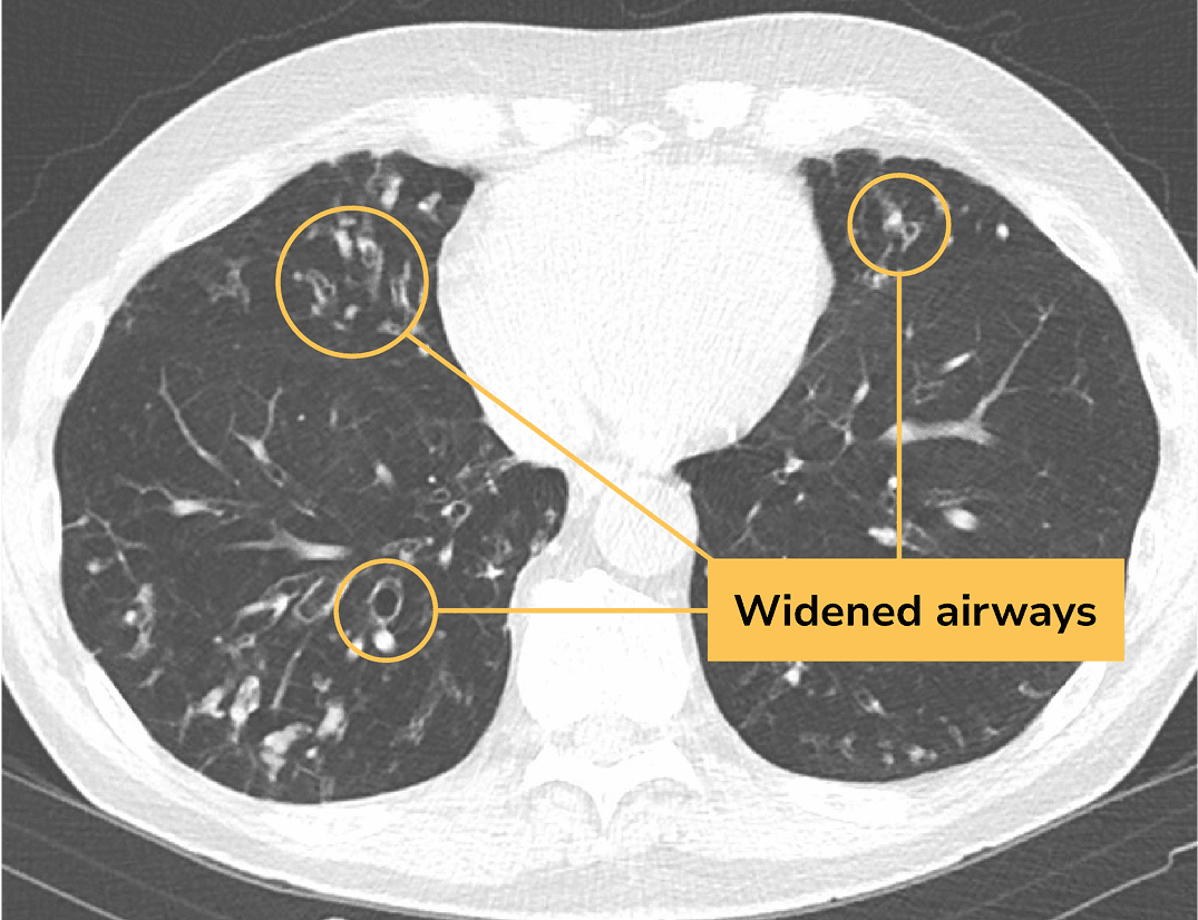 CT scan image of a lung with BE