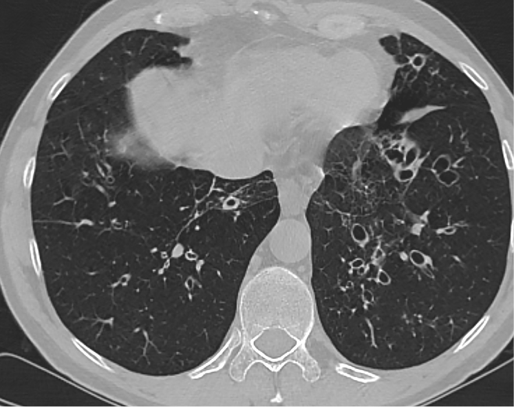 An example of a CT scan showing BE in the lungs