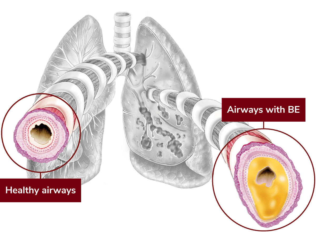 cross-section of healthy airways in lung and airways with BE