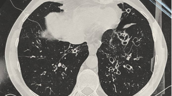 CT scan displaying a pair of lungs affected by bronchiectasis (BE)