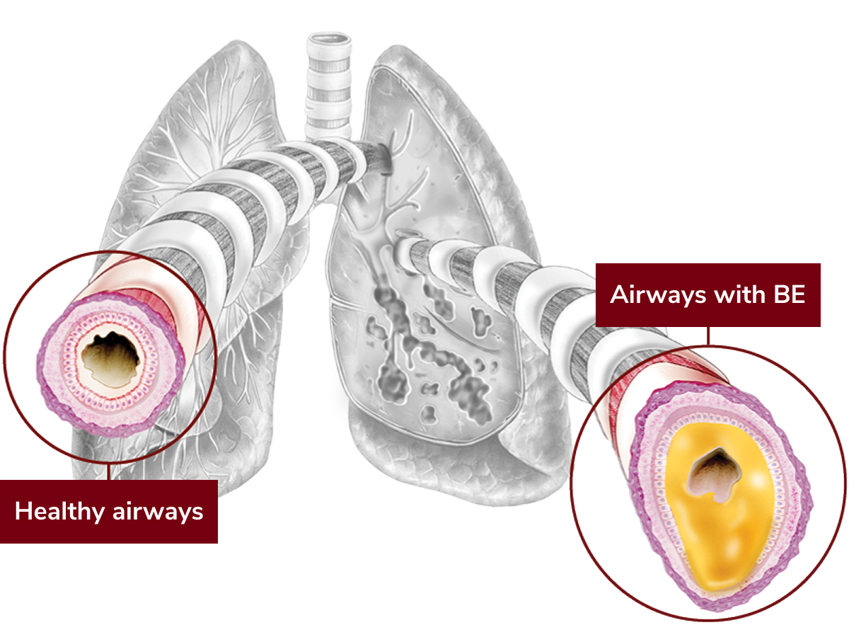 cross-section of healthy airways in lung and airways with BE
